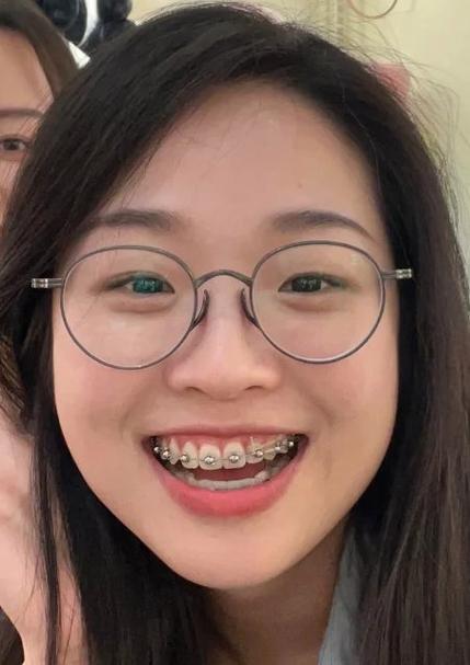 正畸自锁要换几次钢丝-图1 正畸自锁要换几次钢丝-图1