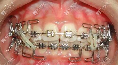 正畸圆丝弓属于哪种正畸弓丝类型？-图2