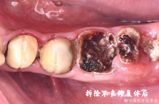 种牙失败具体有哪几种常见情况呢？-图2