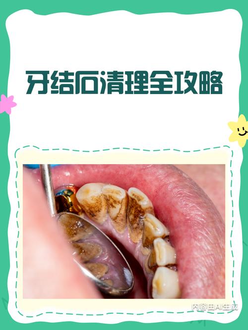 清牙结石最好方法是什么?如何找到最有效且不伤牙的清洁方式?-图2 清牙结石最好方法是什么?如何找到最有效且不伤牙的清洁方式?-图2