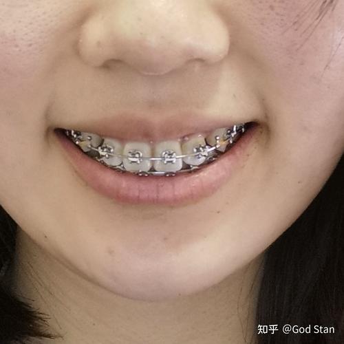 济南市口腔医院正畸效果如何？价格贵不贵？-图2