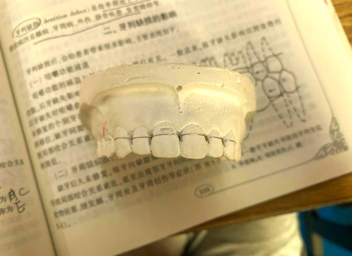 牙齿根折后如何选择固定方法？-图3