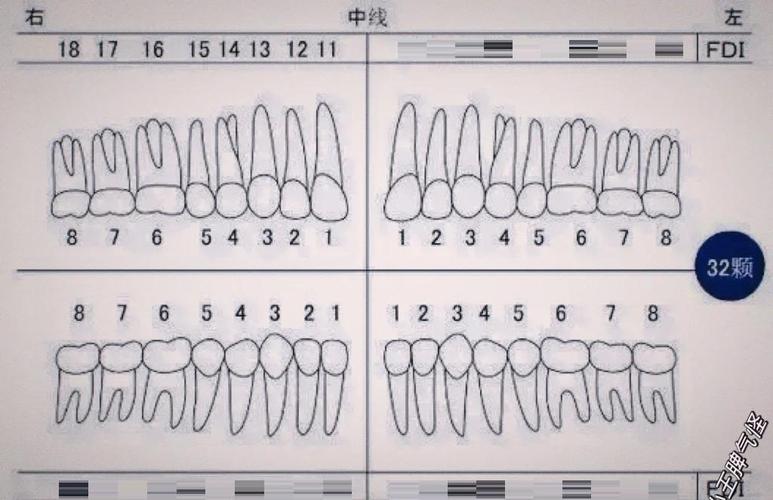 如何正确使用美国牙位记录方法?-图3 如何正确使用美国牙位记录方法?-图3