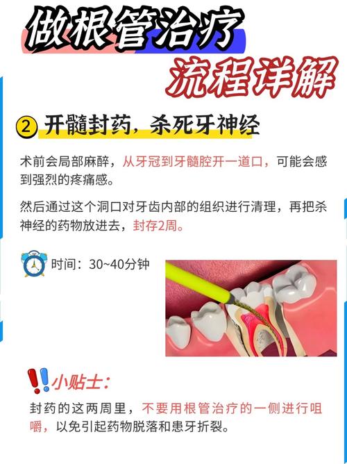 根管治疗怎么治?步骤、效果及注意事项有哪些?-图2 根管治疗怎么治?步骤、效果及注意事项有哪些?-图2