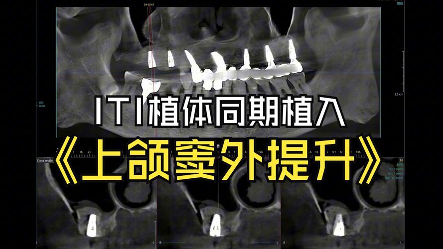 什么是种牙外提升手术?视频详解关键操作步骤-图1 什么是种牙外提升手术?视频详解关键操作步骤-图1