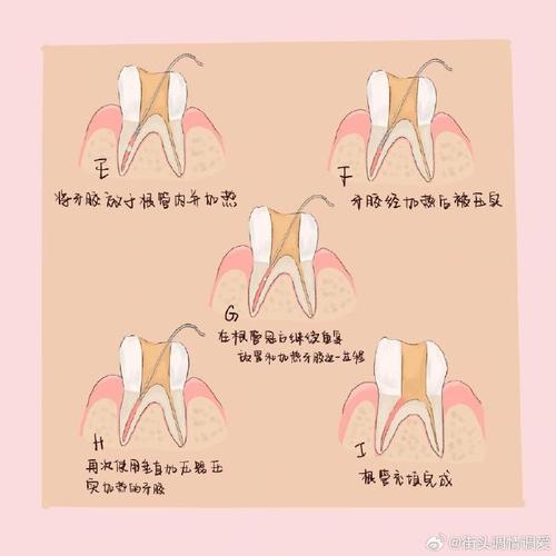 牙体充填术补牙方法-图3