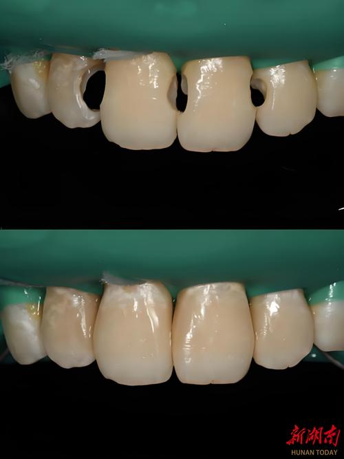 树脂种牙是否需要磨牙?-图2 树脂种牙是否需要磨牙?-图2