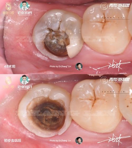 树脂种牙是否需要磨牙?-图3 树脂种牙是否需要磨牙?-图3