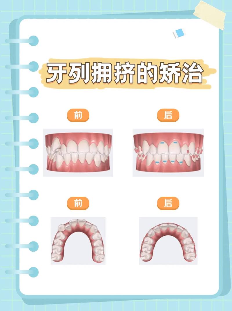 牙齿拥挤用方法最好-图2 牙齿拥挤用方法最好-图2