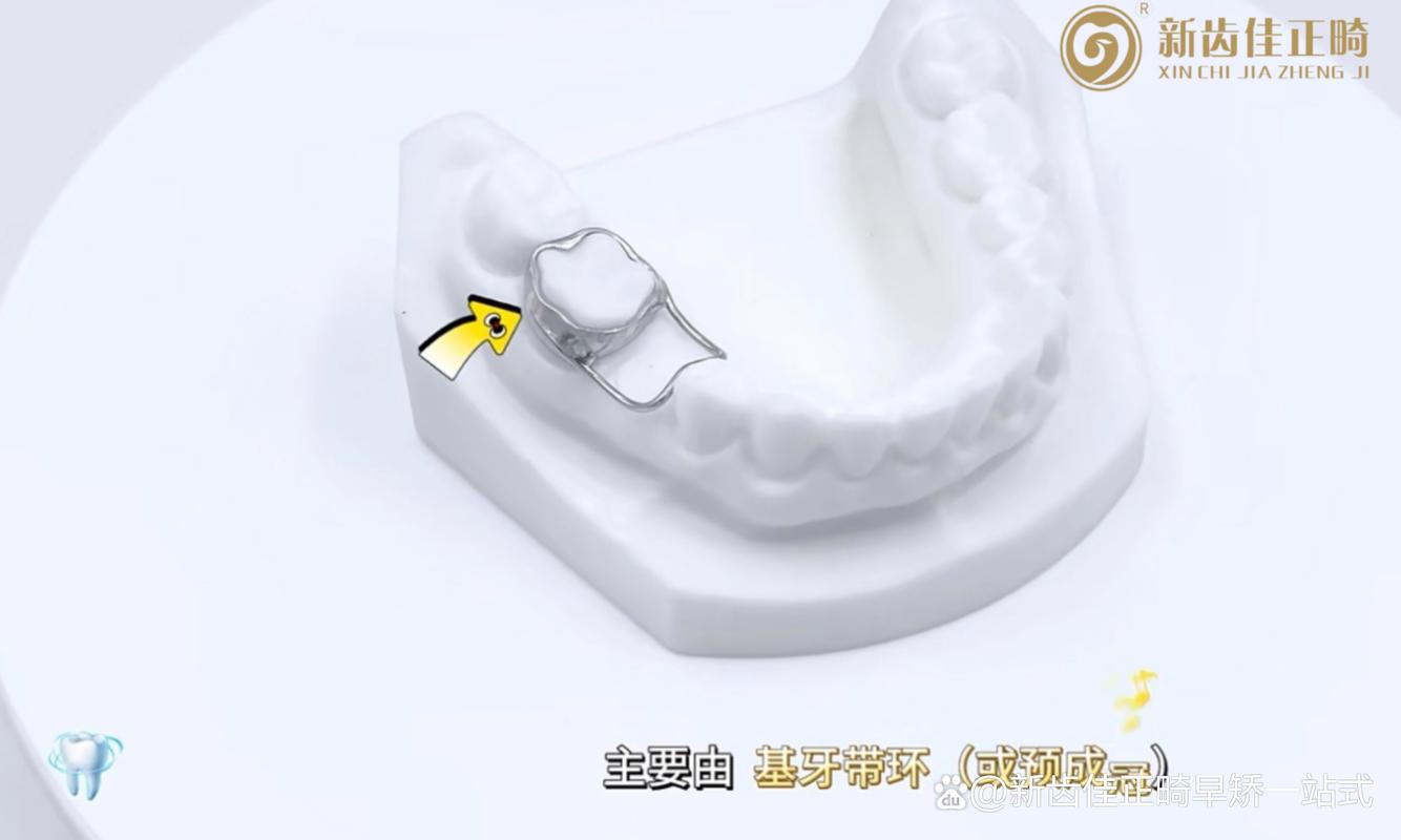 正畸用带环的原因究竟是什么?-图3 正畸用带环的原因究竟是什么?-图3