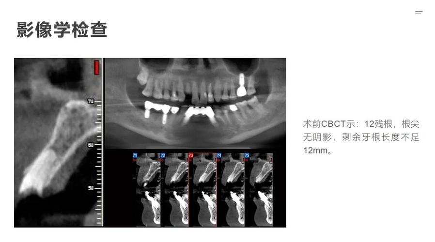种牙外提升手术感受如何?真实体验与术后恢复过程怎样?-图1 种牙外提升手术感受如何?真实体验与术后恢复过程怎样?-图1