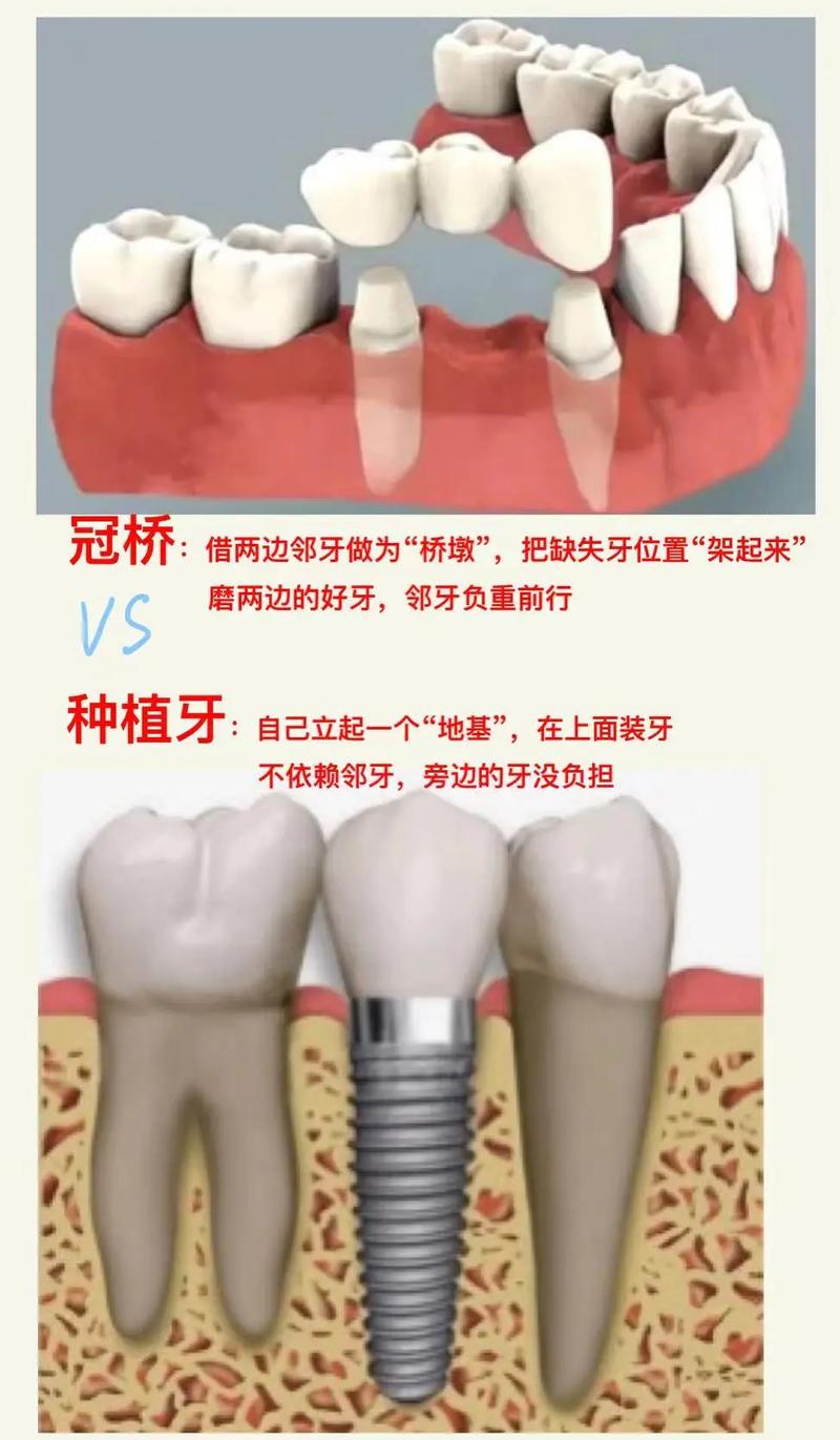 做过瓷牙后还能种牙吗?有影响吗?-图2 做过瓷牙后还能种牙吗?有影响吗?-图2