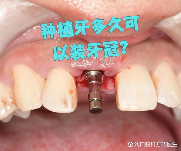 种牙后多久能装牙冠?时间节点是关键?-图2 种牙后多久能装牙冠?时间节点是关键?-图2