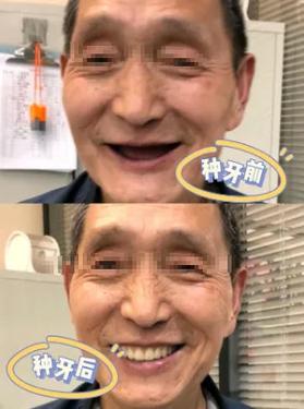 种牙后血压低是何原因？正常吗？-图1