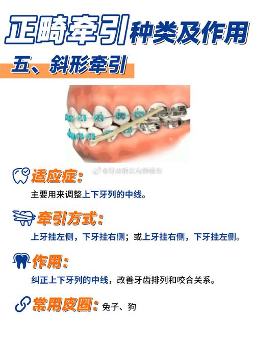 正畸三类牵引皮筋型号有哪些？各自适用于哪些牙齿矫正情况？-图3