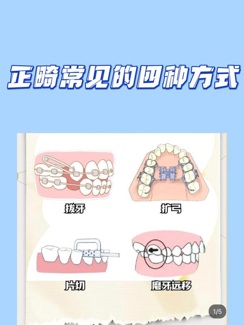 正畸牙矫正方法有几种?不同方法如何选择适合自己的?-图1 正畸牙矫正方法有几种?不同方法如何选择适合自己的?-图1
