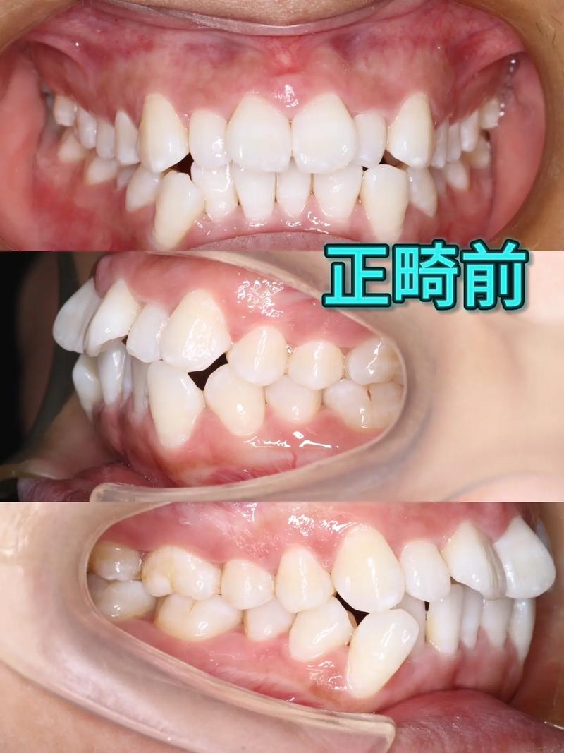 骨性龅牙正畸术改变吗-图3 骨性龅牙正畸术改变吗-图3