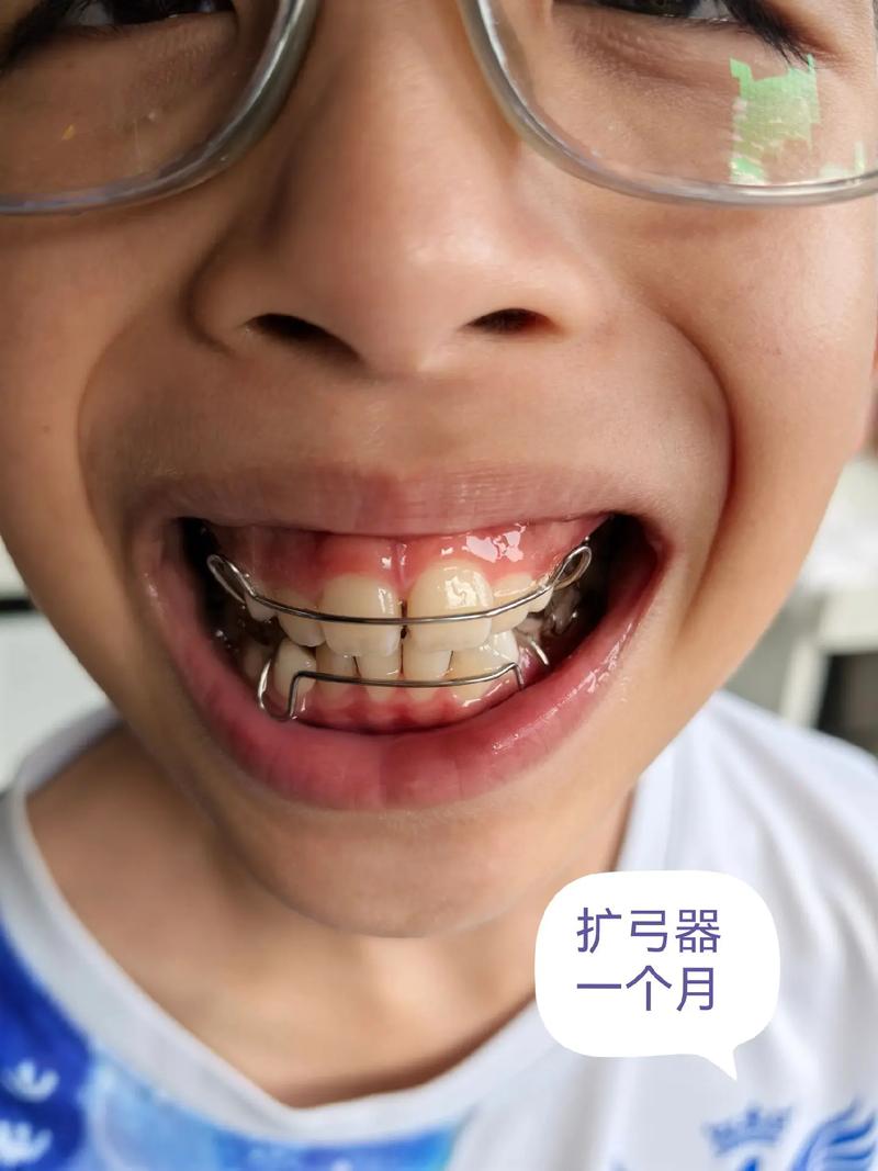 骨性龅牙正畸术改变吗-图1 骨性龅牙正畸术改变吗-图1