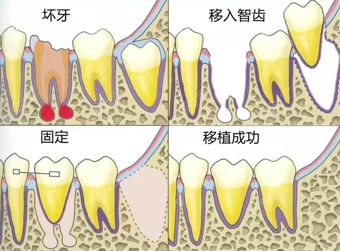 自体牙移植手术方法的具体步骤和要点是什么?-图1 自体牙移植手术方法的具体步骤和要点是什么?-图1