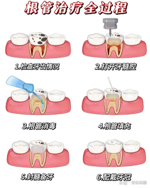 口腔下颌7开髓方法的标准操作流程及操作技巧有哪些?-图1 口腔下颌7开髓方法的标准操作流程及操作技巧有哪些?-图1