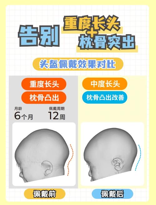 头帽正畸晚上佩戴可行吗？时长和注意事项有哪些？-图1