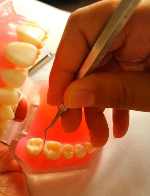 龈上洁治术的操作方法详细流程是怎样的？有哪些关键步骤和注意事项？-图2