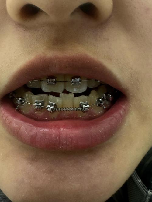 18岁正畸为何会出现牙槽骨吸收？-图2