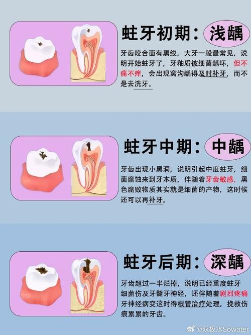 蛀牙治疗,种牙和补牙哪个更合适?如何根据蛀牙情况选?-图2 蛀牙治疗,种牙和补牙哪个更合适?如何根据蛀牙情况选?-图2