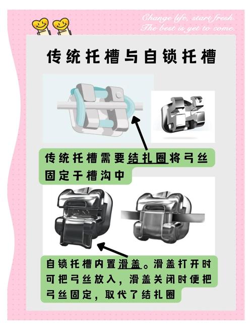 金属托槽夹取如何做到精准高效？关键方法与操作技巧全解析-图2