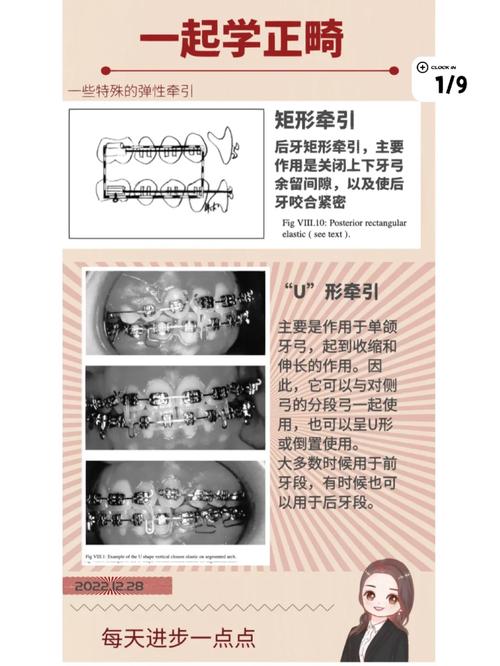 正畸三类牵引是什么?作用与含义解析-图2 正畸三类牵引是什么?作用与含义解析-图2