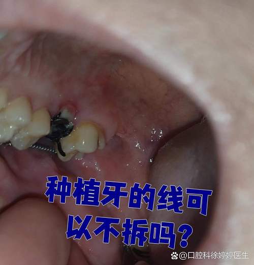 种牙拆线后几天能喝酒?-图3 种牙拆线后几天能喝酒?-图3