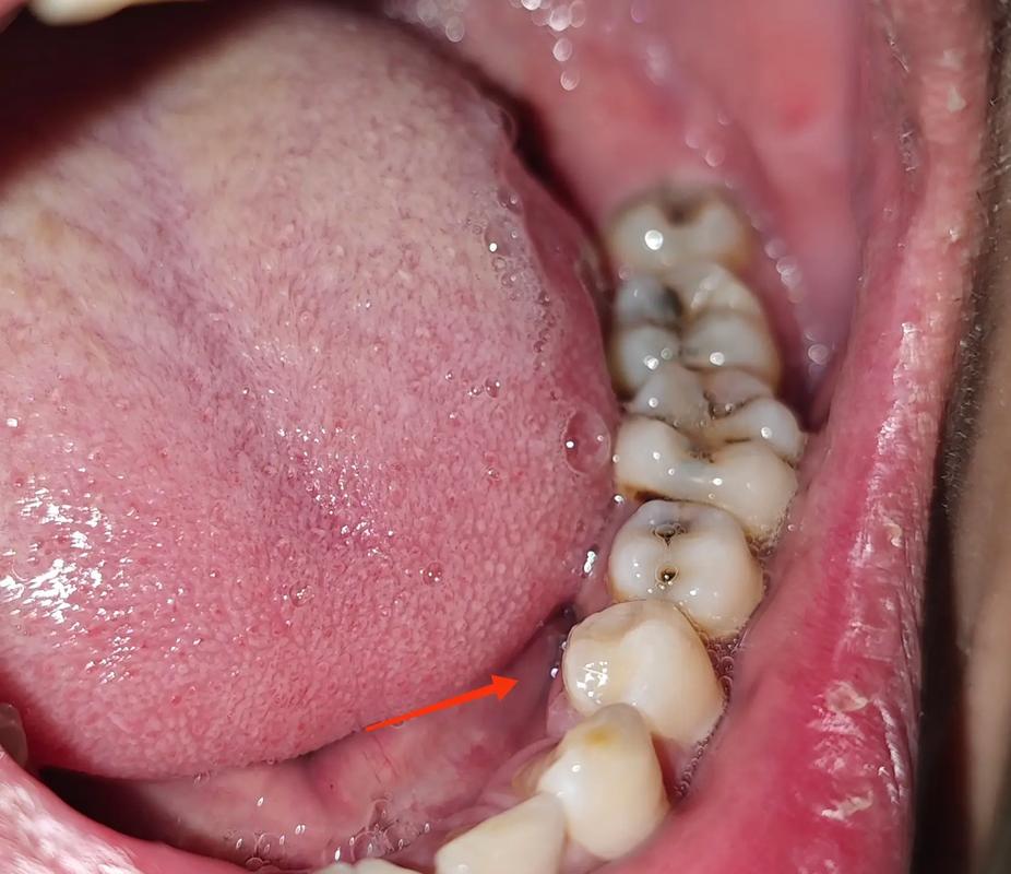 种牙拆线后几天能喝酒?-图2 种牙拆线后几天能喝酒?-图2