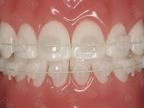 陶瓷托槽摘取法如何安全高效操作?关键步骤与注意事项是什么?-图1 陶瓷托槽摘取法如何安全高效操作?关键步骤与注意事项是什么?-图1