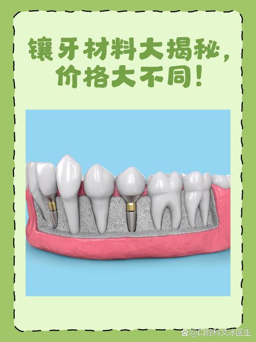 种牙材料哪国最好？进口与国产如何选？-图2