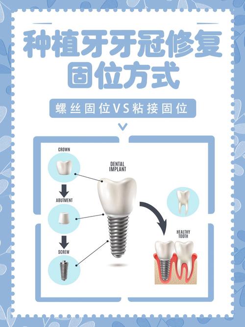 山西哪家医院种牙好？技术与口碑如何选？-图2