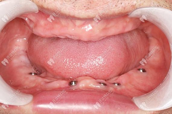 广州口腔医院种牙怎么样？效果和价格如何？-图3