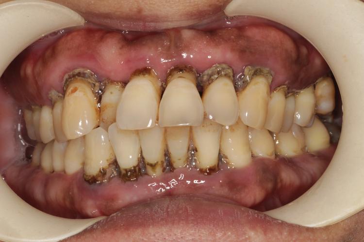 苏州牙周炎种牙贴吧，牙周炎种牙前需治疗吗？流程和费用怎样？-图1