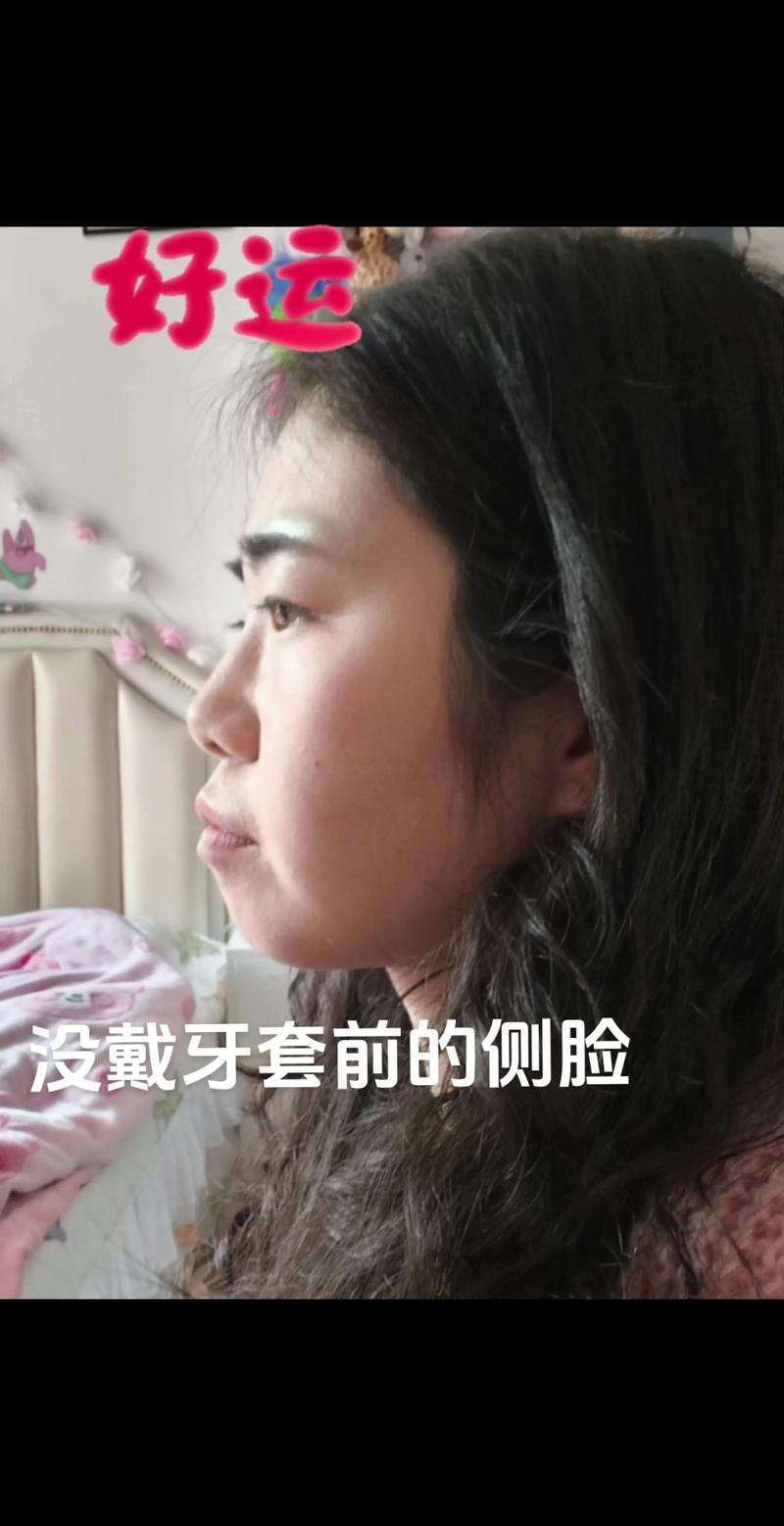 正畸上牙套后多久适应-图3