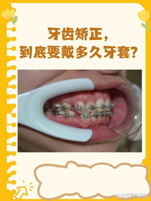 正畸上牙套后多久适应-图2