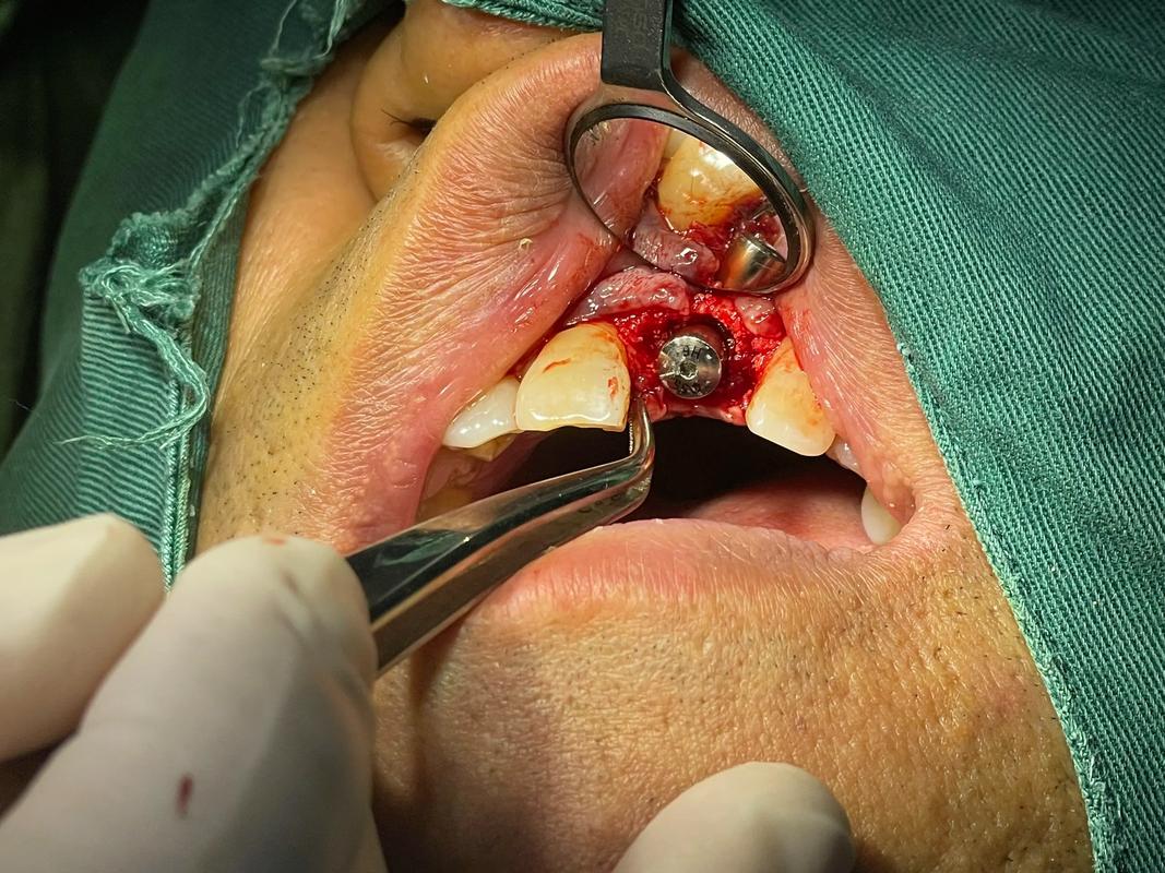 2025年种植牙过程会比现在更简单高效吗？-图3