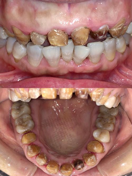 正畸后烤瓷牙牙龈红肿,是材料刺激还是正畸影响?-图2 正畸后烤瓷牙牙龈红肿,是材料刺激还是正畸影响?-图2