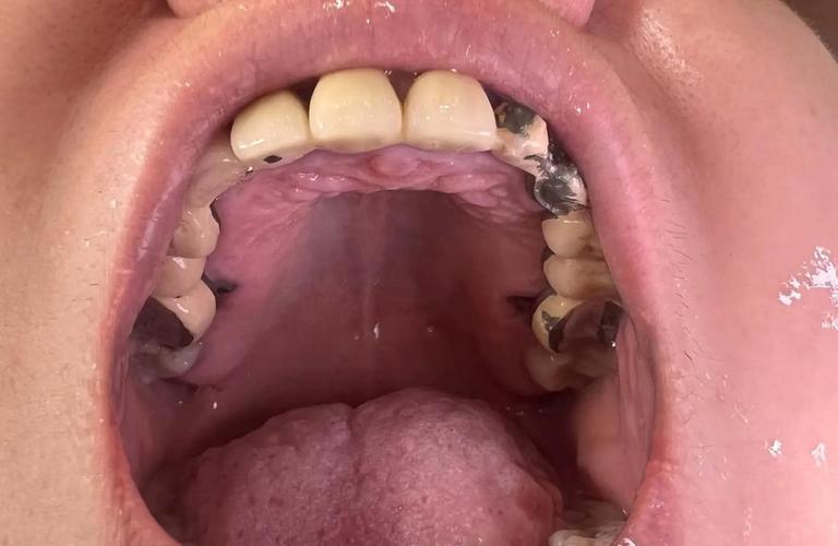 正畸后烤瓷牙牙龈红肿，是材料刺激还是正畸影响？-图1