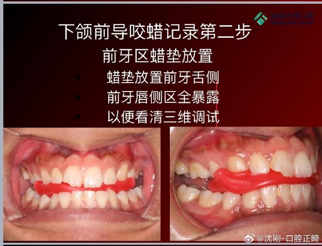 正畸保护蜡取不出来怎么办？-图1