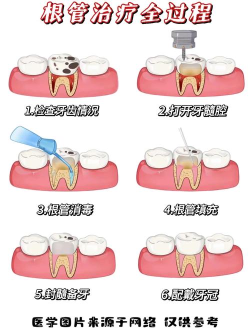 常用的根管预备方法-图3
