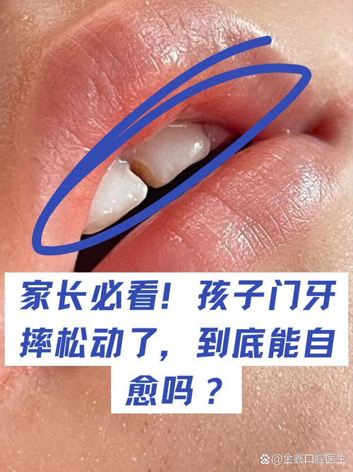 正畸门牙松动正常吗?是什么原因导致的?该怎么处理?-图3 正畸门牙松动正常吗?是什么原因导致的?该怎么处理?-图3