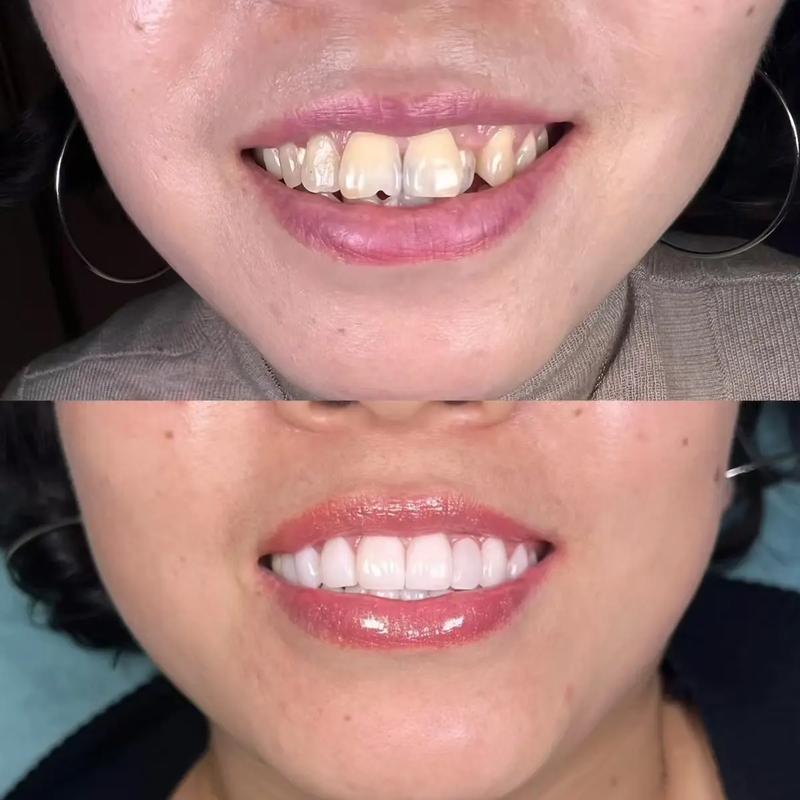 瓜子牙有多种修复方法，如何根据牙齿缺损程度选择最适合的修复方式？-图2