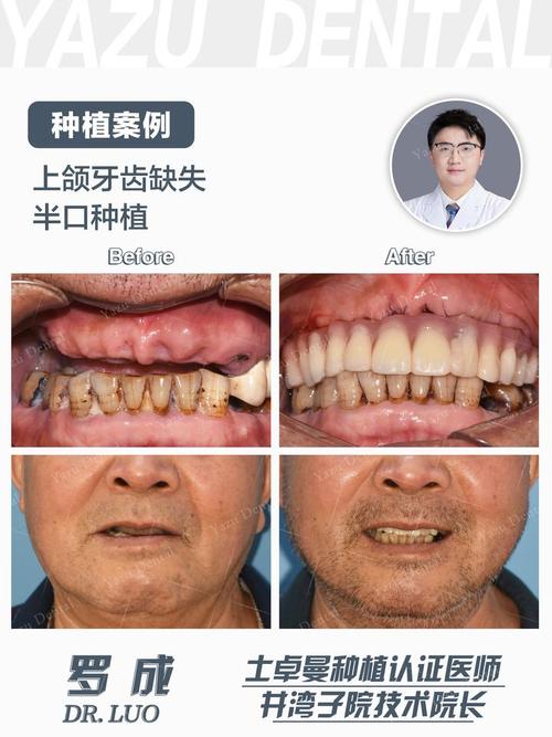 上颌骨缺损修复方法有哪些临床选择与应用策略？-图3