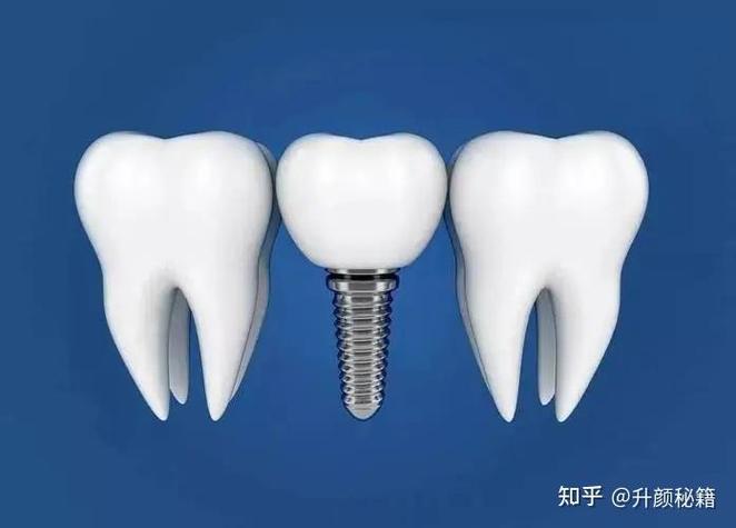 嘉兴种牙哪家医院好？如何选靠谱又专业的正规种牙机构？-图1