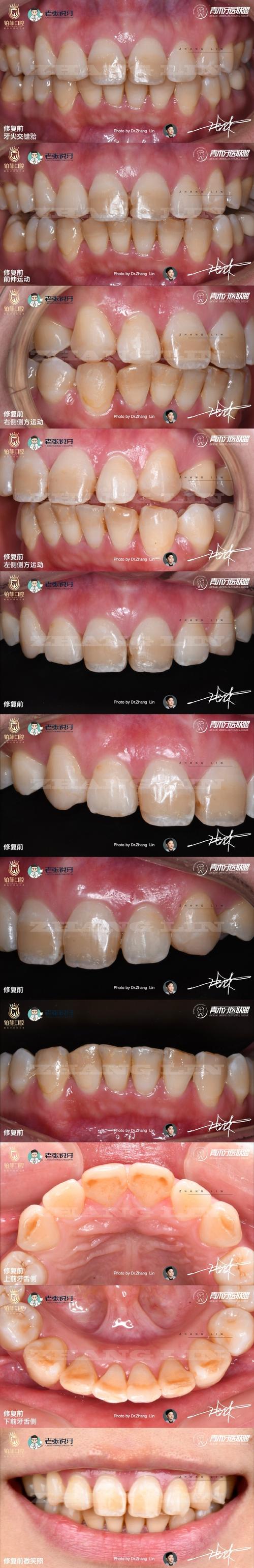 烤瓷牙在进行正畸粘结处理过程中，如何确保粘结效果持久安全？-图2