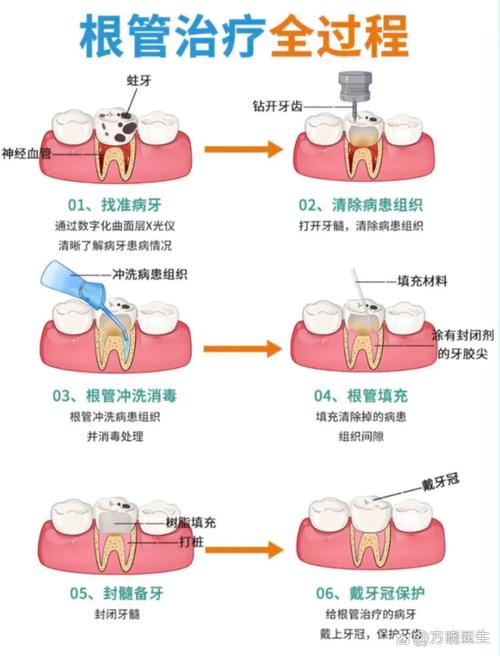 根管预备有哪些方法？如何确保预备效果与安全？-图1